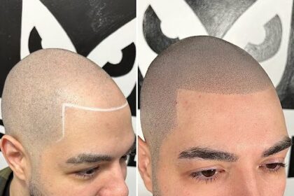 micro-scalp-pigmentation-nyc:-the-latest-trends-and-innovations-in-hair-restoration