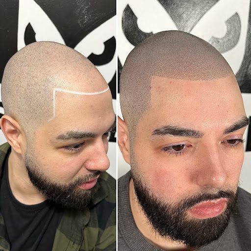 micro-scalp-pigmentation-nyc:-the-latest-trends-and-innovations-in-hair-restoration